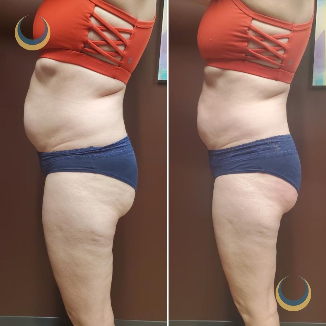 Tummy Tuck Before & Afters, Omaha