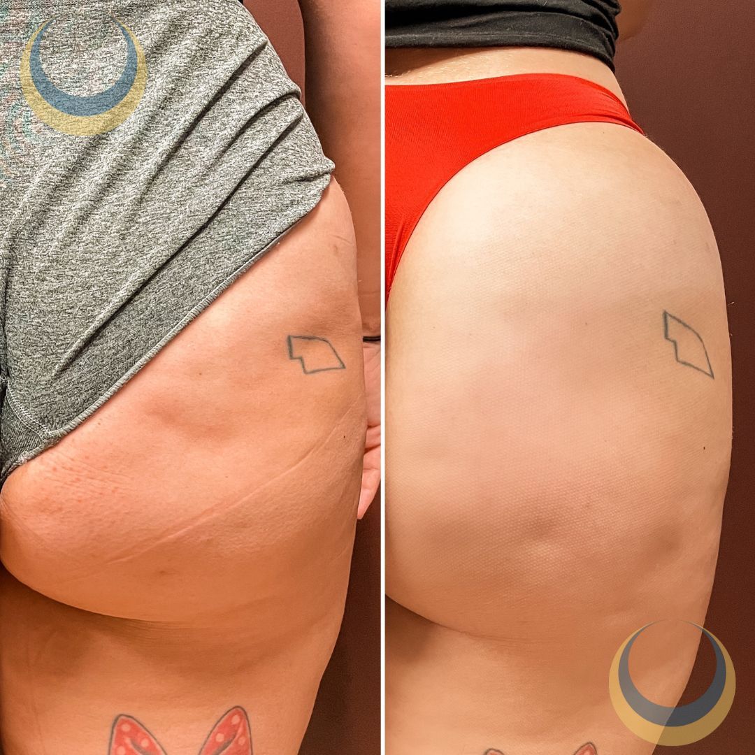 Before and after body sculpting Images | BodySculpt Labs By Sakoon in Omaha NE