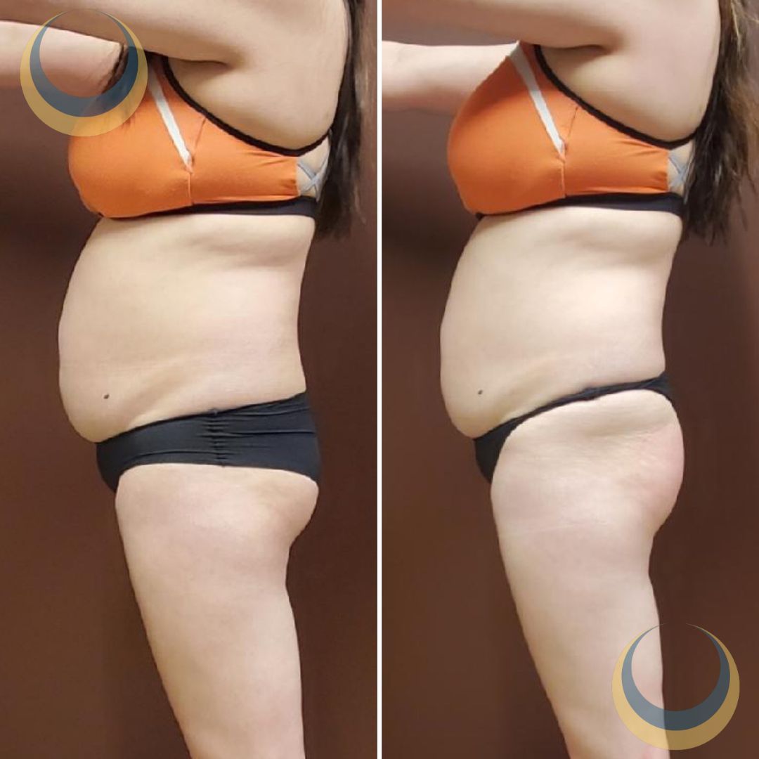 Tummy Tuck Before & Afters, Omaha