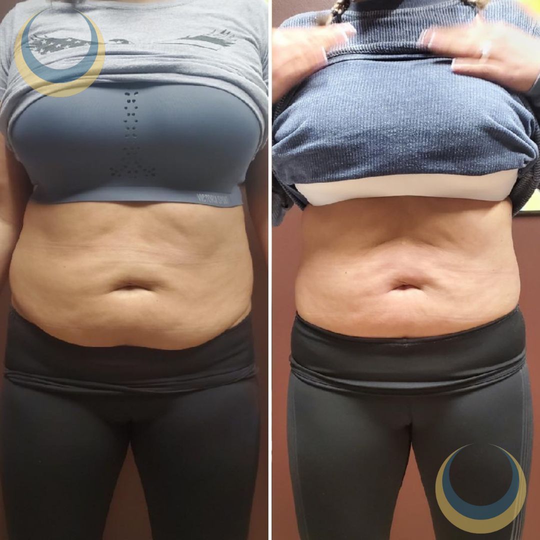 Before and after body sculpting Images | BodySculpt Labs By Sakoon in Omaha NE