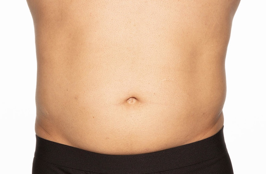 Before and after body sculpting Results Images | BodySculpt Labs By Sakoon in Omaha NE