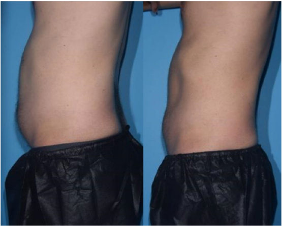 visceral fat reduction Results Images | BodySculpt Labs By Sakoon in Omaha NE